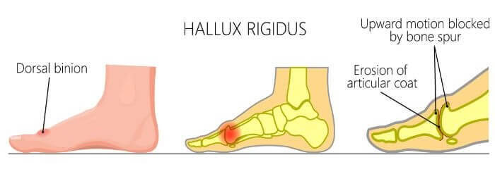 Hallux Rigidus