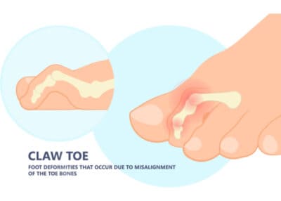 Signs and Symptoms of Claw Toes