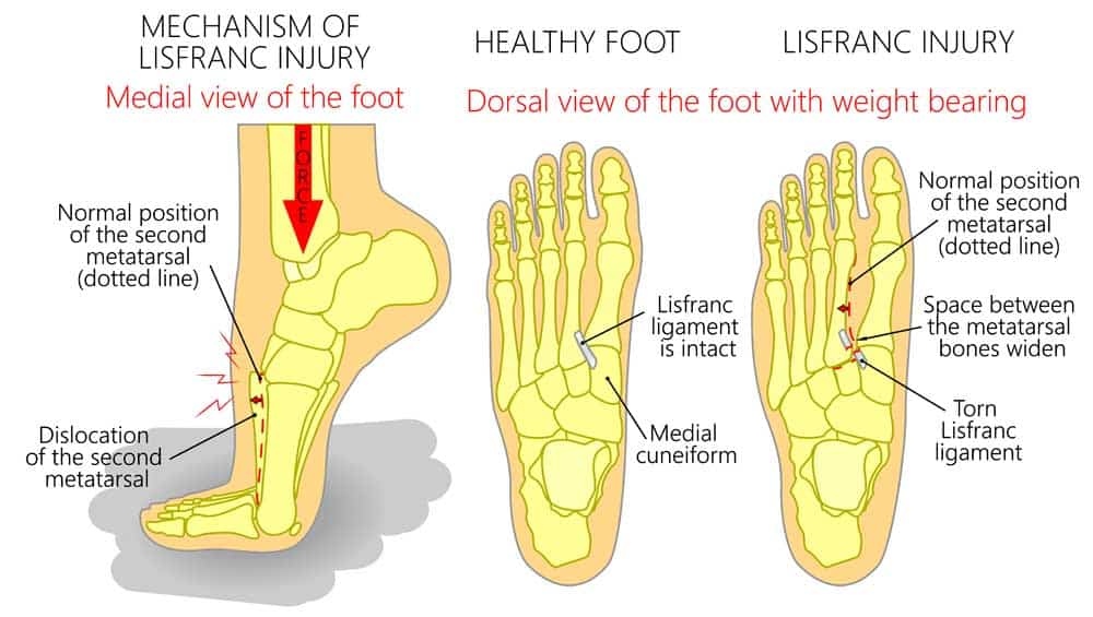 Lisfranc Injury Specialist Lisfranc Treatment Vail Frisco Denver Co