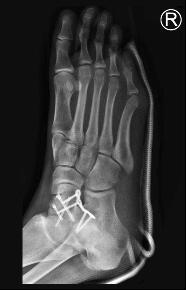 talus fracture