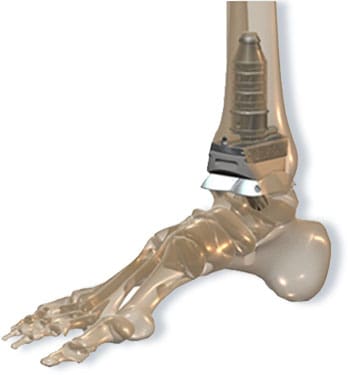 Video On Ankle Joint Replacement