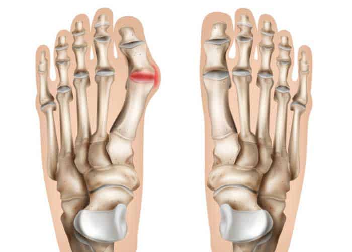 Bunion Correction Surgery | Lapiplasty 3D | Orthopedic Foot And Ankle ...