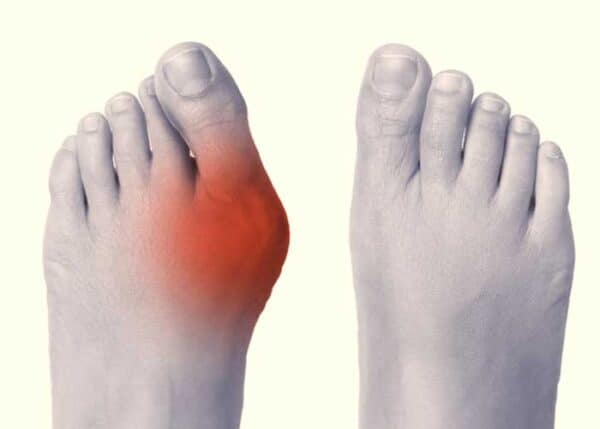 Bunion Correction Surgery | Lapiplasty 3D Ankle Specialist | Vail ...