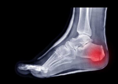 calcaneus fracture swelling