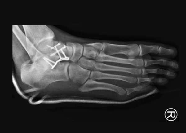 Ankle fracture surgery, broken ankle