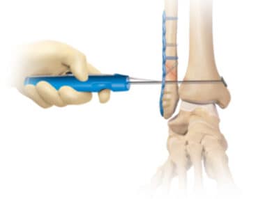 Syndesmosis TightRope™ Implant | Ankle Sprain and Ankle Fracture ...