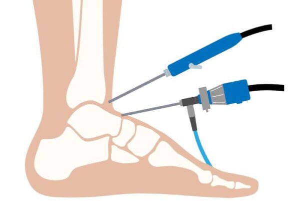 Ankle Arthroscopy| Surgery | Vail, Colorado, Eagle Mountain Range